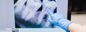 A Closer Look at Tooth Decay Claims